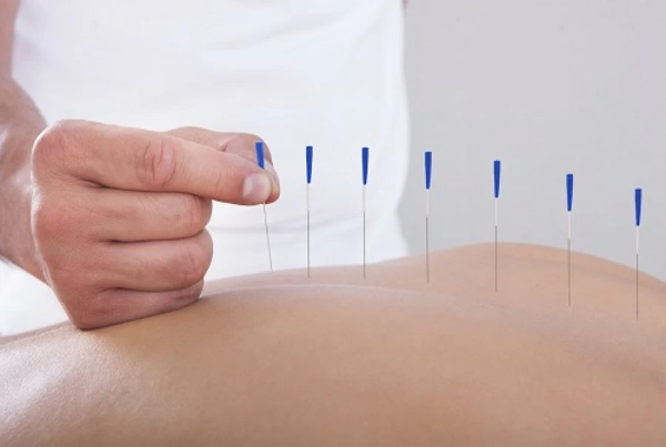 Dry Needling Acupuncture